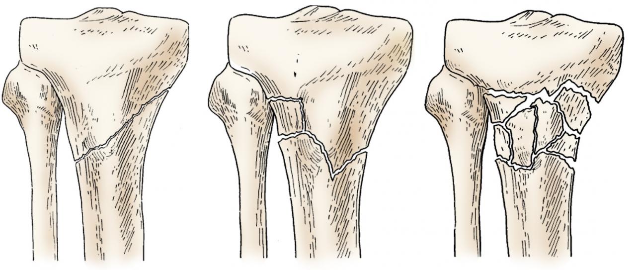 Acute management of open fractures an evidence based review